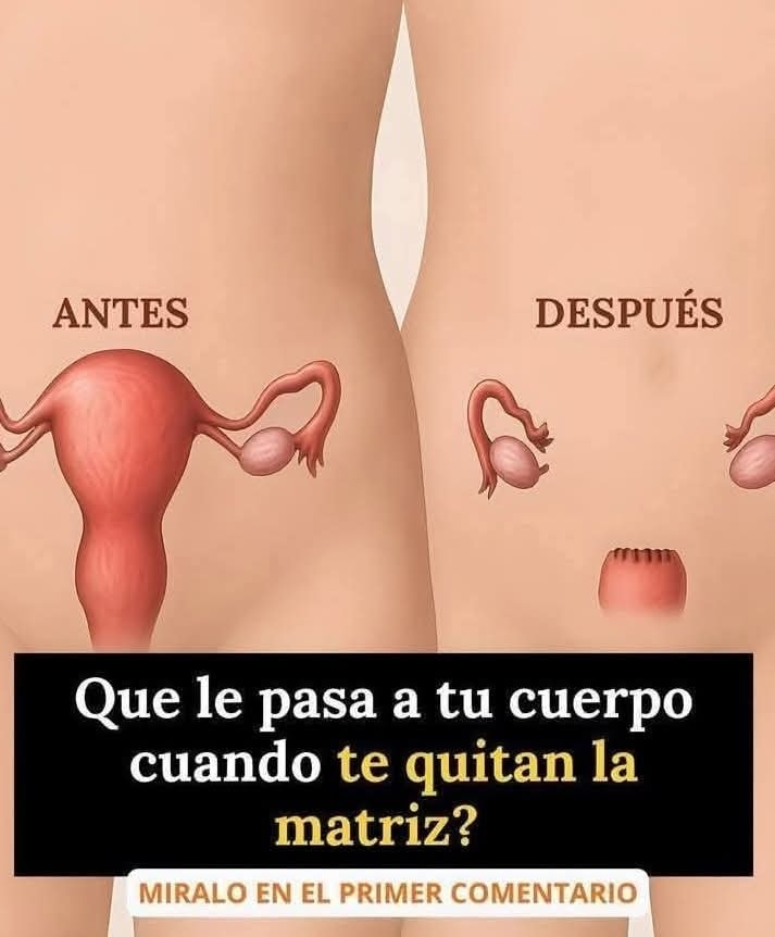 Esquema de Histerectomía