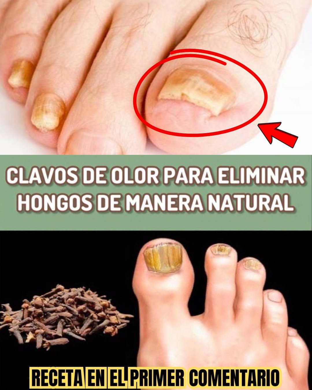 Clavos de olor para combatir hongos en las uñas