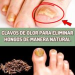 Eliminar Hongos en las Uñas de Forma Natural con Clavos de Olor
