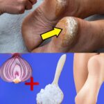 5 Remedios Caseros para Talones Agrietados que Realmente Funcionan