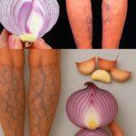 Elimina las Várices: Remedios Naturales con Ajo y Cebolla