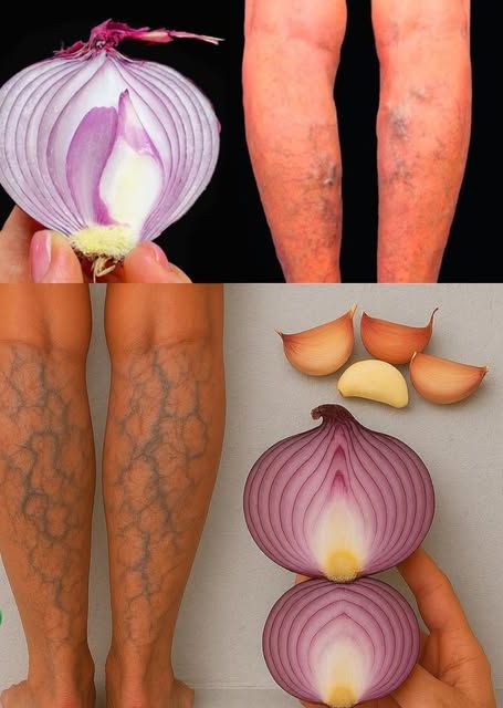 Remedio natural para várices con cebolla y ajo
